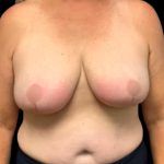 Breast Reduction Before & After Patient #5595