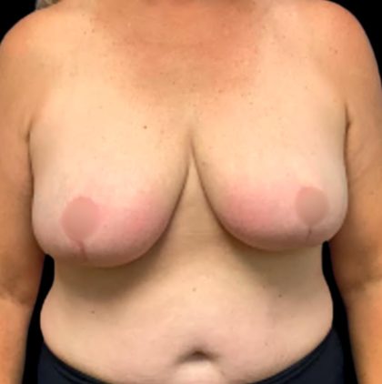 Breast Reduction Before & After Patient #5595