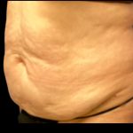 Tummy Tuck Before & After Patient #5592