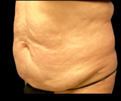 Tummy Tuck Before & After Patient #5592