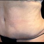 Tummy Tuck Before & After Patient #5592