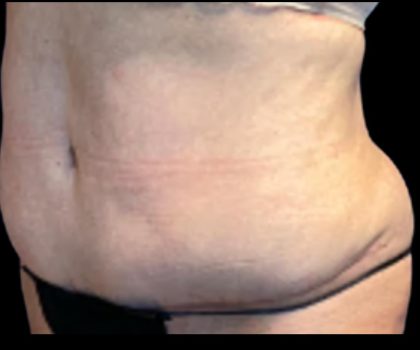 Tummy Tuck Before & After Patient #5592