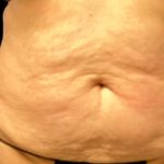 Tummy Tuck Before & After Patient #5592