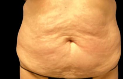 Tummy Tuck Before & After Patient #5592