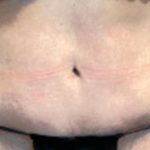 Tummy Tuck Before & After Patient #5592