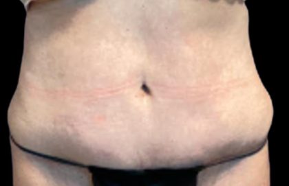 Tummy Tuck Before & After Patient #5592