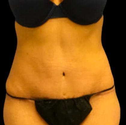 Vaser Liposuction Before & After Patient #5593