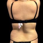 Vaser Liposuction Before & After Patient #5593
