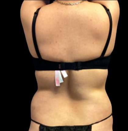 Vaser Liposuction Before & After Patient #5593