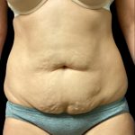 Tummy Tuck Before & After Patient #5654