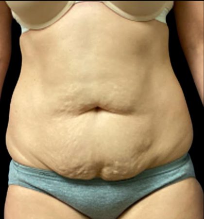 Tummy Tuck Before & After Patient #5654