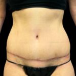 Tummy Tuck Before & After Patient #5654