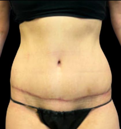 Tummy Tuck Before & After Patient #5654