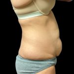 Tummy Tuck Before & After Patient #5654