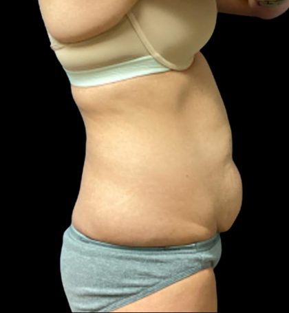 Tummy Tuck Before & After Patient #5654