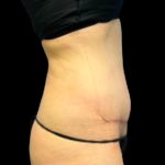 Tummy Tuck Before & After Patient #5654