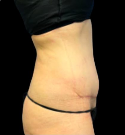 Tummy Tuck Before & After Patient #5654