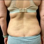 Tummy Tuck Before & After Patient #5654