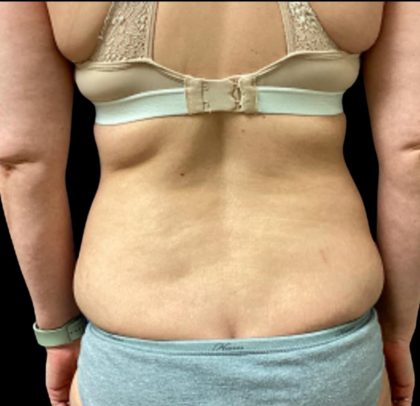 Tummy Tuck Before & After Patient #5654
