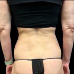 Tummy Tuck Before & After Patient #5654