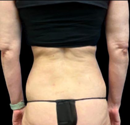 Tummy Tuck Before & After Patient #5654