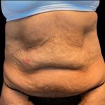 Tummy Tuck Before & After Patient #5653
