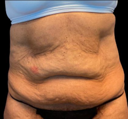 Tummy Tuck Before & After Patient #5653