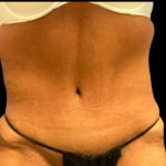 Tummy Tuck Before & After Patient #5653