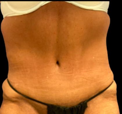Tummy Tuck Before & After Patient #5653