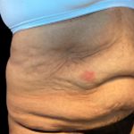 Tummy Tuck Before & After Patient #5653