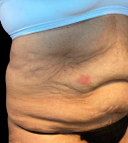 Tummy Tuck Before & After Patient #5653