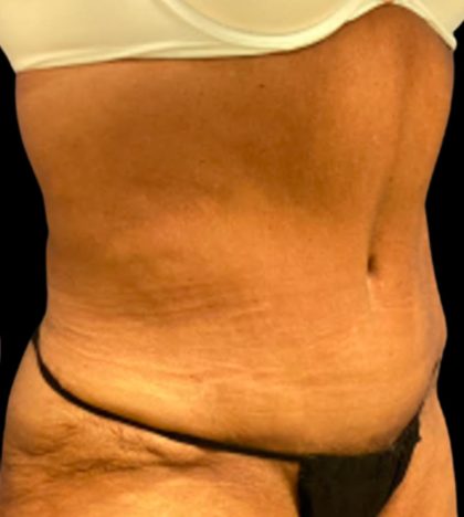 Tummy Tuck Before & After Patient #5653