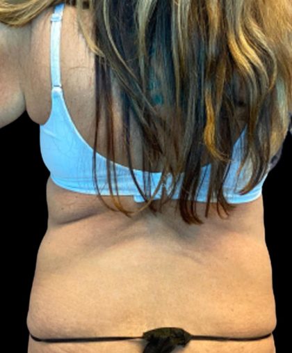 Liposuction Before & After Patient #5655