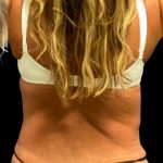 Liposuction Before & After Patient #5655