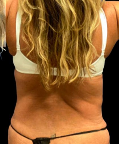 Liposuction Before & After Patient #5655