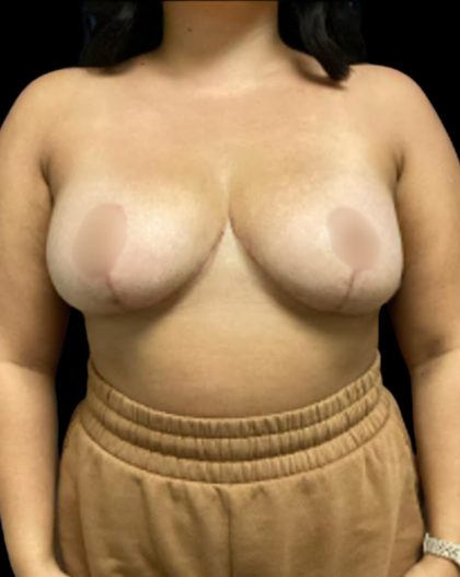 Breast Reduction Before & After Patient #5656