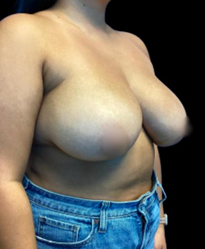 Breast Reduction Before & After Patient #5656