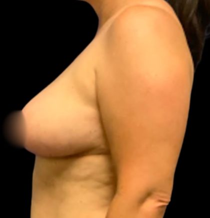 Breast Reduction Before & After Patient #5594