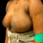 Breast Reduction Before & After Patient #5657