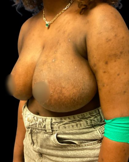 Breast Reduction Before & After Patient #5657
