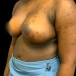 Breast Reduction Before & After Patient #5657