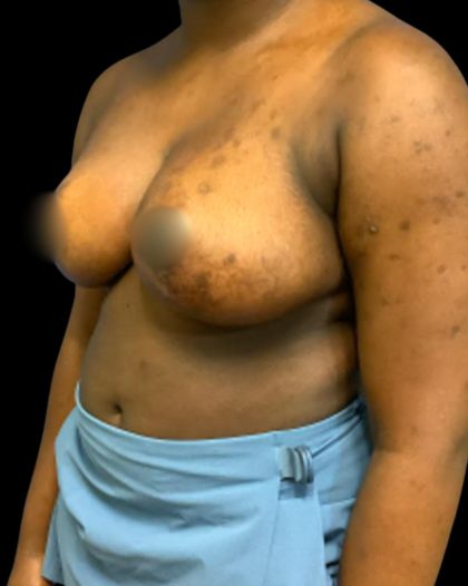 Breast Reduction Before & After Patient #5657