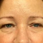 Blepharoplasty Before & After Patient #5658