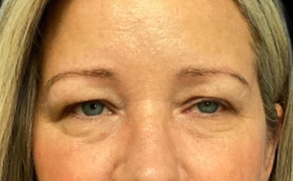Blepharoplasty Before & After Patient #5658