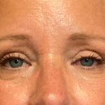 Blepharoplasty Before & After Patient #5658