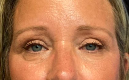 Blepharoplasty Before & After Patient #5658