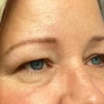 Blepharoplasty Before & After Patient #5658