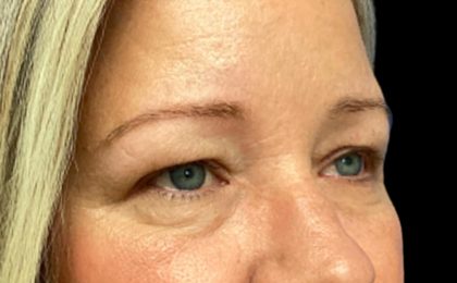 Blepharoplasty Before & After Patient #5658