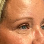 Blepharoplasty Before & After Patient #5658