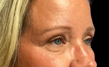 Blepharoplasty Before & After Patient #5658